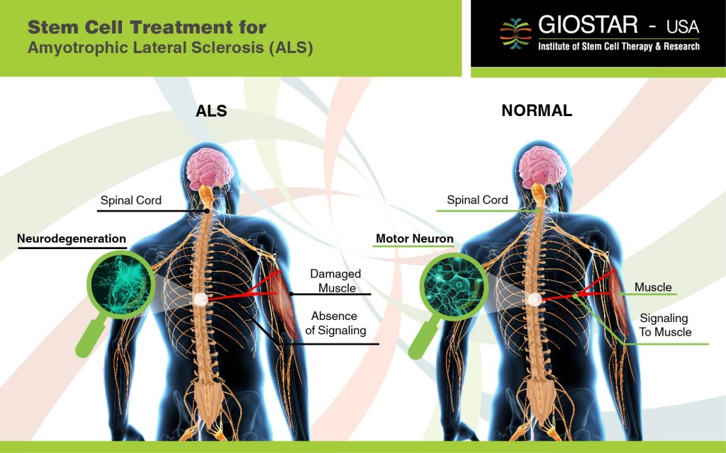 Amyotrophic Lateral Sclerosis